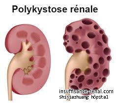 L’état de maladie de patients de polykystose rénale