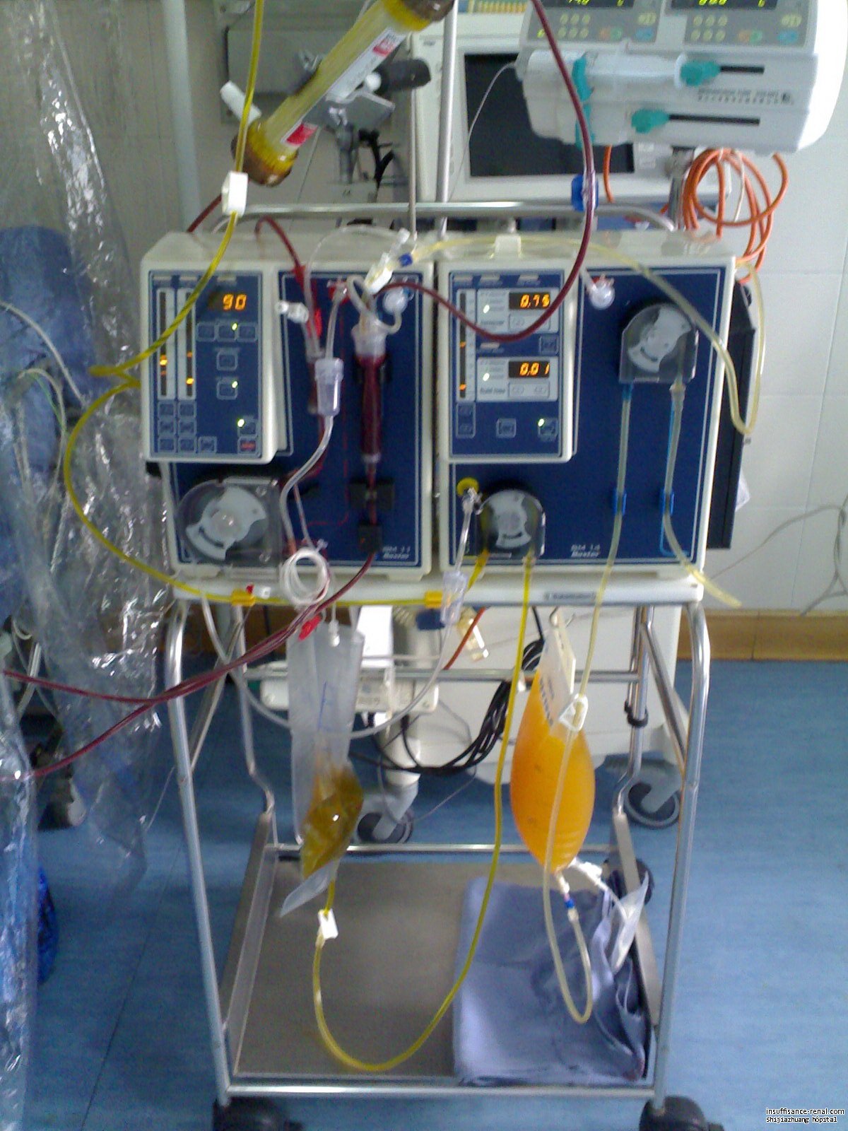 La plasmaphérèse dans l'hôpital de néphrologie de Shijiazhuang