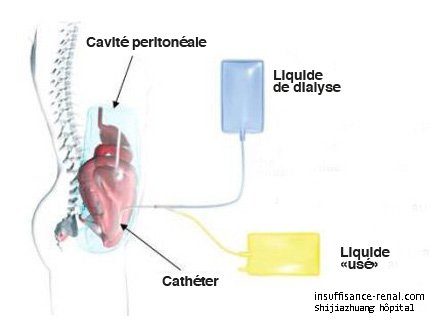 La dialyse péritonéale pour l’insuffisance rénale terminale