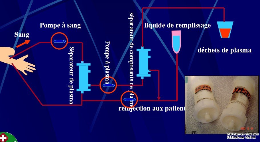 Une petite presentation La Plasmaphérèse pour la maladie néphrotique sévère