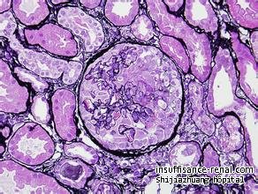  Comment empêcher le progress de la maladie FSGS à l'insuffisance rénale 