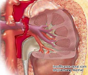 PKD avec le rein élargi de taille de 16 cm et 19 cm