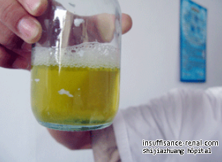 Est l’urine mousseuse sûrement causé par la maladie rénale 