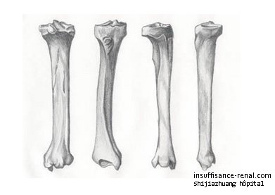 Avez-vous la maladie des os d'insuffisance rénale