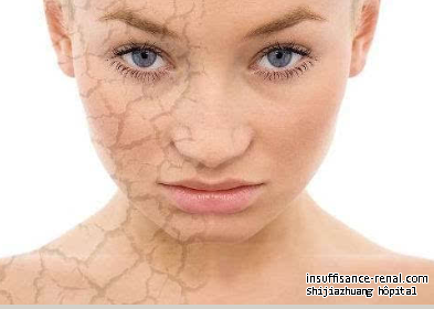 La peau sèche est provoqué par la maladie rénale