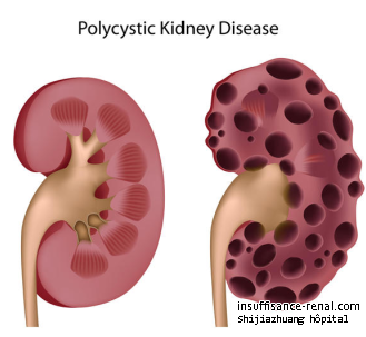 Quels sont les symptômes de PKD (polykystique des reins maladie)