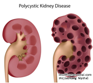 Maladie polykystique des reins: vous devriez en savoir plus dans cet article