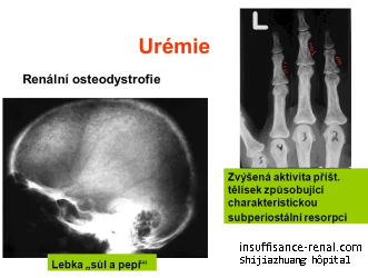 Urémie, aucune augmentation d'urine de sortie Pour 700ml avec des traitements de médecine chinoise