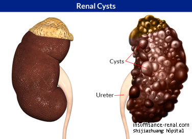 Kyste rénal Causes Mon Tummy à l'oedème: Que dois-je faire