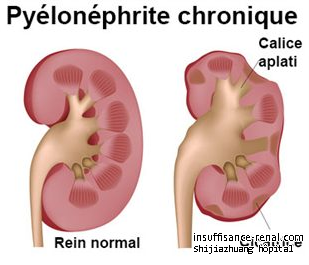 Traitement Pour pyélonéphrite