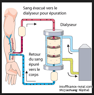 Insuffisance rénale terminale sans dialyse