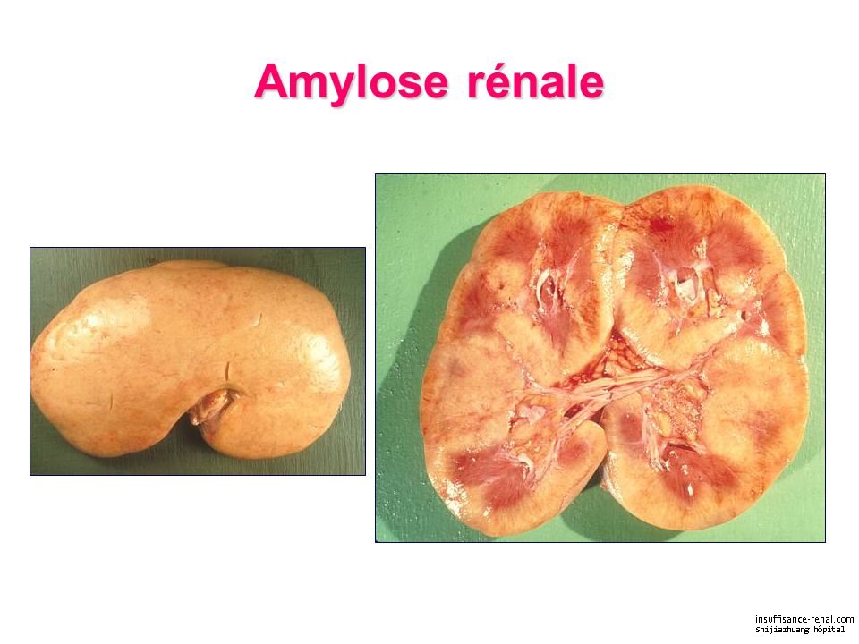 Traitement efficace contre l’amylose rénale