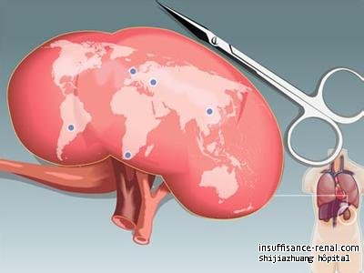 Comment récupérer la fonction rénale efficacement? Vous choisissez la transplantation rénale ?