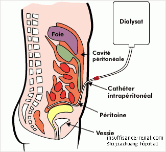 Pourquoi la dialyse peut soulager les symptômes du taux de créatinine élevé ? 	