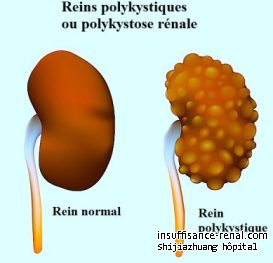 Les kystes du rein causent de la douleur au pénis