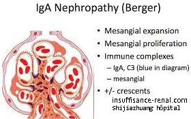 Quel est le meilleur traitement pour la néphropathie des IgA