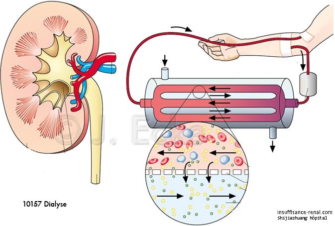 la dialyse péritonéale ou la hémodialyse