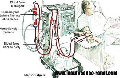 Quel niveau de créatinine est évité dialyse