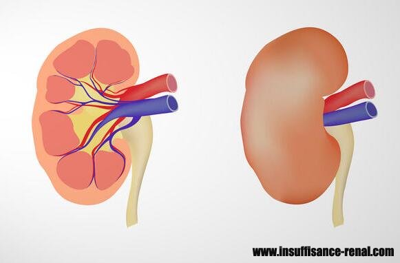 Rein atrophié: Causes, Symptômes, Traitement